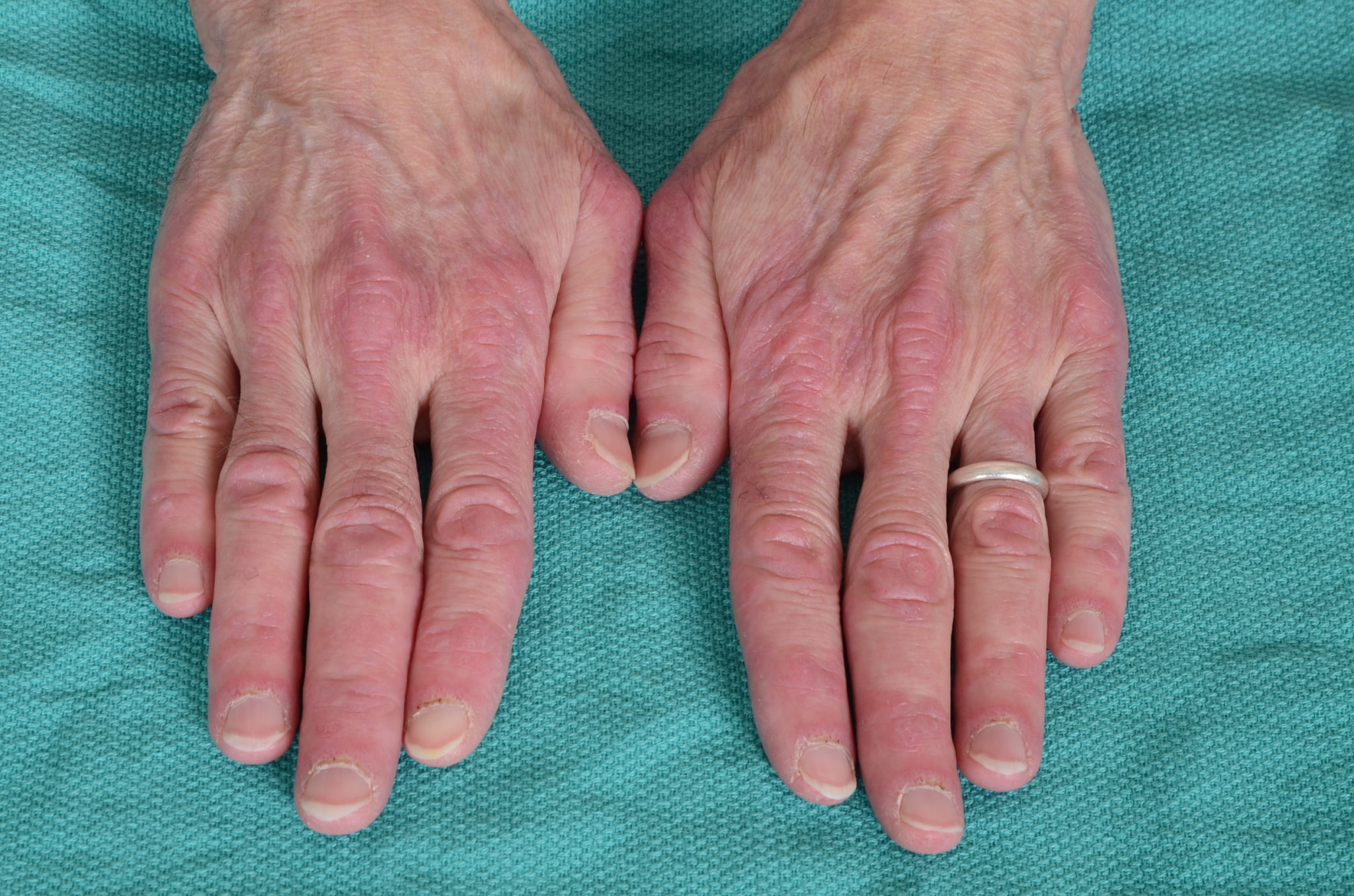 Dermatomiozit-2048x1356