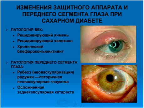 glaza