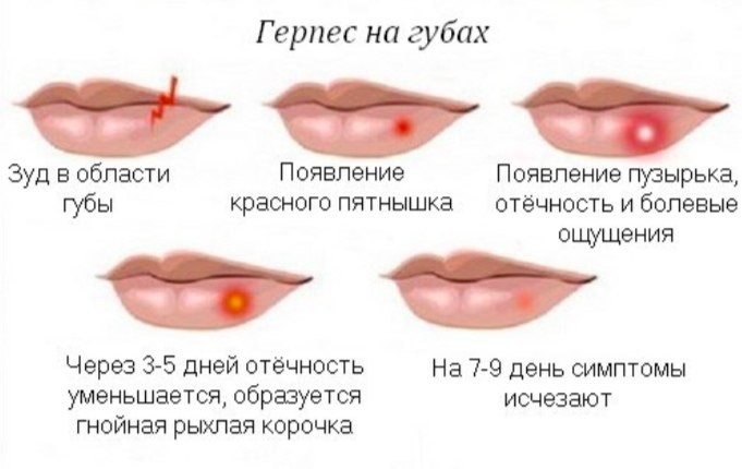 gerp4
