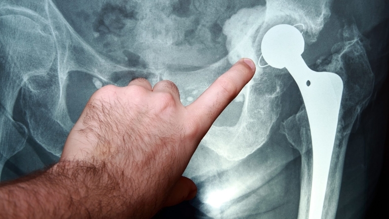 Osteoporoz reng