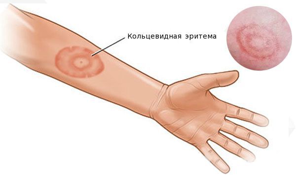 kleshch eritema