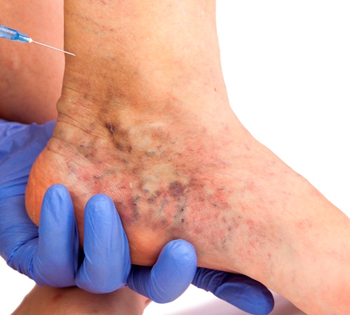 diabeticheskaya stopa